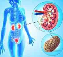 Pietre la rinichi: simptome la femei și bărbați. Cum sa scapi de pietre la rinichi?