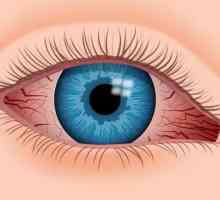 Picături pentru ochi vasoconstrictive: aplicarea și numele preparatelor