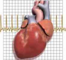Cardioscleroza inimii: simptome, tratament, cauze