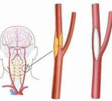 Endarterectomia carotidă: indicații, perioada postoperatorie, complicații, revizuiri ale…