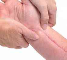 Cicloide și cicatrici hipertrofice: descriere, tipuri, cauze și tratament