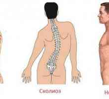 Kifoskolioza coloanei vertebrale toracice: tipuri și tratament