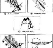 Cusătură intestinală: specie. Modalități de conectare a peretelui intestinal