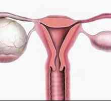 Chistul ovarului stâng, tipurile și tratamentul acestuia