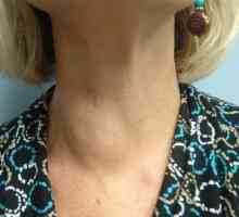 Chistul glandei tiroide - este periculos? Tratamentul chistului tiroidian