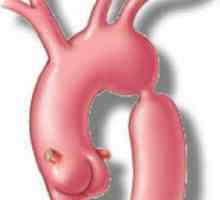 Coarctarea aortei este ceea ce? Coarctarea aortei la copii