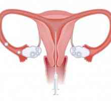 Când se utilizează inseminarea intrauterină?