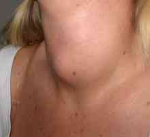 Guiderul coloidal al glandei tiroide - ce este? Cum să tratezi un glomeraj coloidal al glandei…