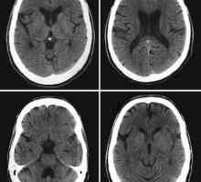 Tomografia computerizată a creierului: o revizuire a procedurii