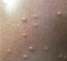 Moluscul contagios la un copil, tratamentul pielii