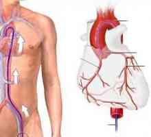 Angiografia coronariană a vaselor inimii: cum o fac, costul, complicațiile. Angiografia coronariană…
