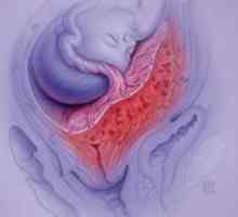 Placenta previa regională - o amenințare la cursul normal al sarcinii