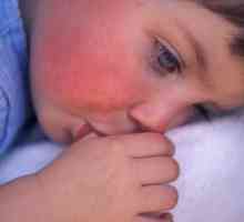 Punctul roșu pe obrazul copilului: cauze, manifestări și caracteristici ale tratamentului