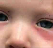 Roșeață sub ochii unui copil: cauze și tratament