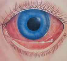 Proteine ​​de ochi roșii: cauze, efecte și metode de tratament. De ce sunt ochii roșii în vârstă…
