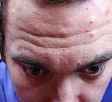 Cum de a elimina acnee roșie pe frunte?