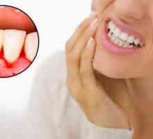 Sângerarea gingiilor: tratament la domiciliu cu remedii folclorice. Pasta de dinti provenita din…