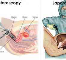 Laparoscopie și histeroscopie: indicații, recenzii, ceea ce este mai bine