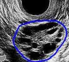 Laparoscopia ovarului polichistic: pregătirea, administrarea și perioada postoperatorie