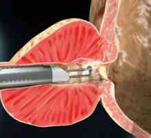Vaporizarea laser a colului uterin: o descriere a procedurii și a indicațiilor