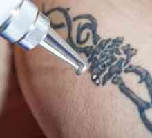 Îndepărtarea cu laser a tatuajului - descrierea procedurii, caracteristici și recenzii