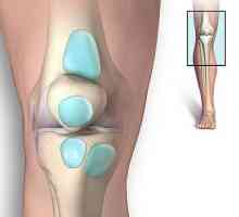 Tratamentul bursitei articulației genunchiului: revenim la ușurință la mers