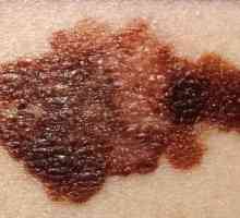Tratamentul melanomului: metode de bază