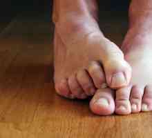Tratamentul ciupercilor pe picioare cu remedii folclorice