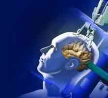 Tratamentul tumorilor cerebrale în Israel - metode inovatoare