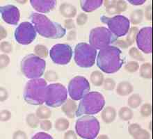 Leucemia: ce este aceasta și există o șansă pentru mântuire?