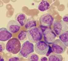 Leucemia - ce este? Cât de corect să diagnosticați?