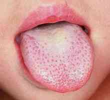 Leucoplakia limba: cauze, simptome, tratament