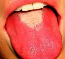 Zmeura limbii: cat de periculos este simptomul?