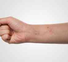 Unguentele pentru dermatita: o revizuire și caracteristicile aplicației