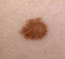 Melanomul: Ce este? Simptomele bolii, prevenirea și tratamentul melanomului