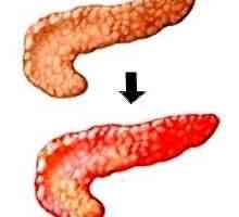 Meniu cu pancreatită ca o componentă importantă a tratamentului