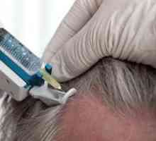 Mezoterapia scalpului: recenzii