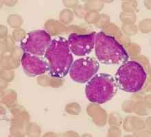 Myeloleucemia - ce este? Leucemia mieloidă cronică: cauze, tratament, prognostic