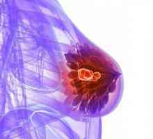 Microcalcinatele din glanda mamară - ce este? Cauze, diagnosticare