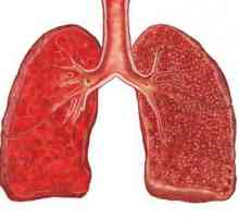 Tuberculoza mucoasă a plămânului: forme, diagnostic, simptome, tratament
