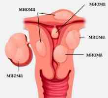 Fibrele uterine: cauze, tratament, consecințe
