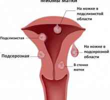 Fibroame uterine: simptome, cauze, tratament