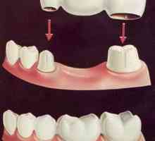 Poduri: argumente pro și contra. Recomandări dentare și feedback pacient