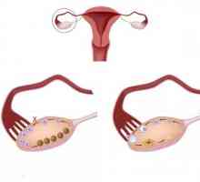 Ovare multifolliculară - ce este? Cauzele obișnuite ale diagnosticului și constatările greșite…