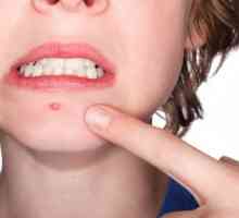 Remedii populare pentru acnee și acnee pe față și medicamente