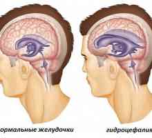 Hidrocefalie externă a creierului la adulți: semne și tratament