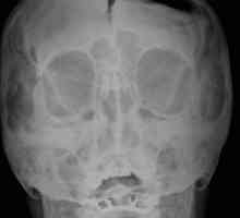 Cât de periculoase sunt fracturile de bază ale craniului
