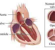 Aortic valve deficiență 1, 2, 3 grade: semne, simptome, diagnostic, tratament