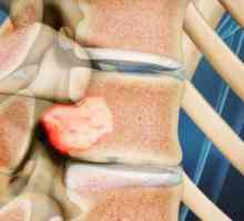 Neurinomul coloanei vertebrale: simptome, cauze și tratament