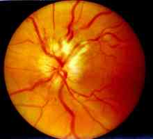 Nevrită optică: cauze, simptome, diagnostice și trăsături de tratament